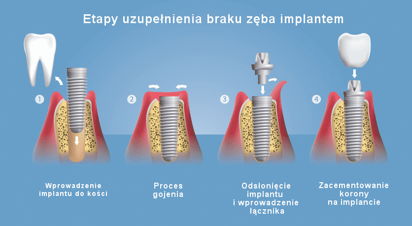 Etapy uzupełniania braku zęba implantem - jak wygląda zabieg implantacji?