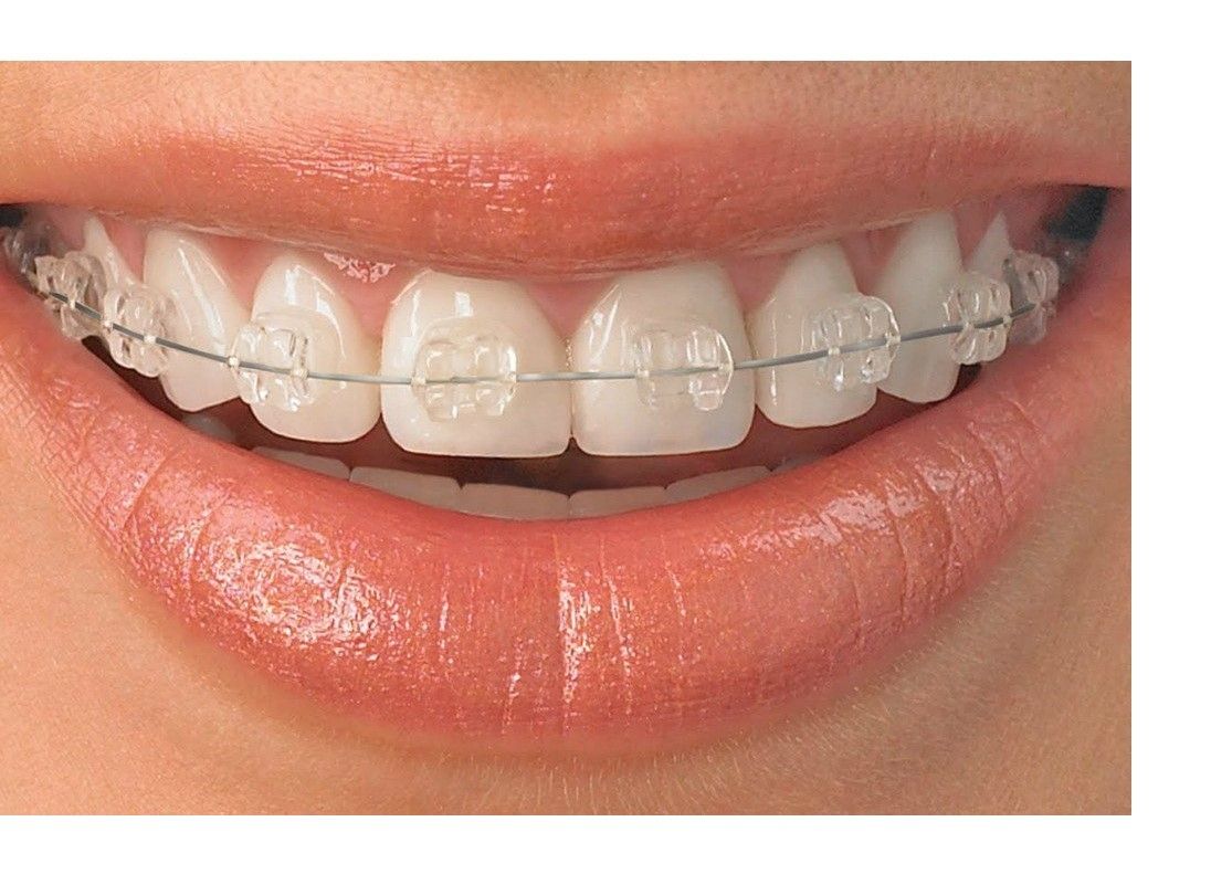 kosmetyczny ortodontyczny aparat na zęby