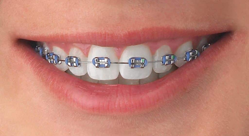 aparat na zęby metalowy