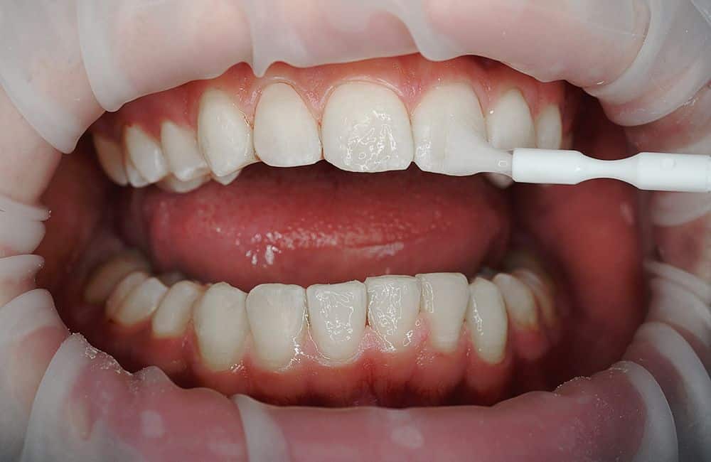 fluoryzacja zębów warszawa
