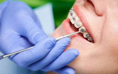Ortodoncja – czym jest i na czym polega?