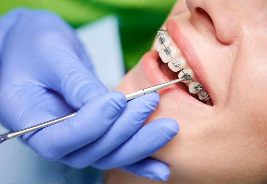 Ortodoncja – czym jest i na czym polega?