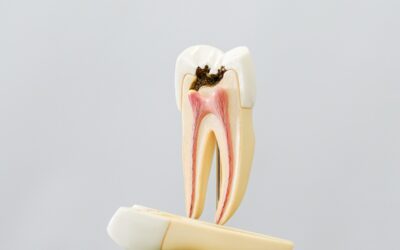 Czy próchnica zębów jest zaraźliwa?